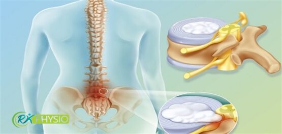 فیزیوتراپی کمر در سعادت آباد تهران