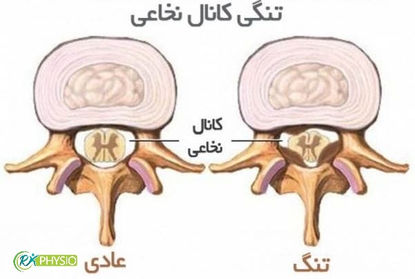 هزینه فیزیوتراپی تنگی کانال نخاع در سعادت آباد تهران