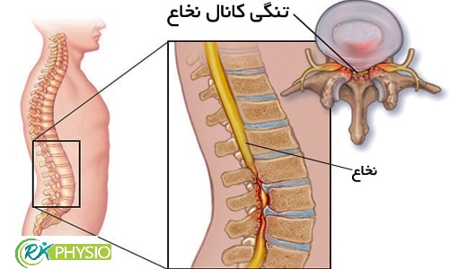 هزینه فیزیوتراپی تنگی کانال نخاع در سعادت آباد تهران