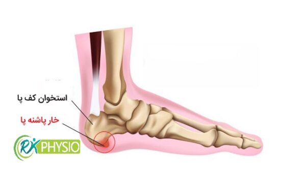 درمان خارپاشنه با فیزیوتراپی آرکا در سعادت آباد تهران