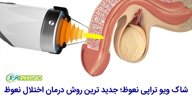 درمان اختلال نعوظ با شاک ویو تراپی در سعادت آباد تهران