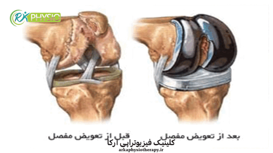 فیزیوتراپی بعد از تعویض مفصل زانو در سعادت اباد تهران