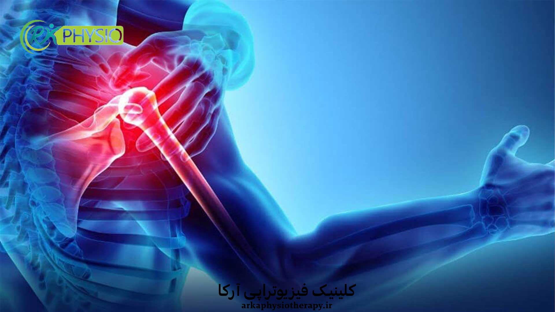 درمان فیزیوتراپی شانه یخ زده