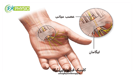 درمان سندرم تونل کارپال در سعادت آباد تهران