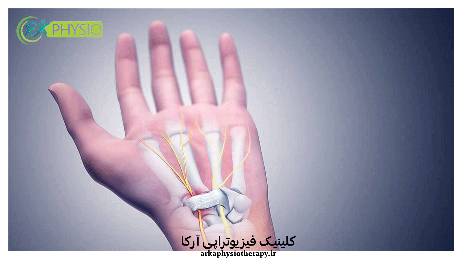 درمان سندرم تونل کارپال در سعادت آباد تهران