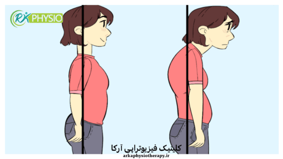 درمان عارضه سر به جلو با فیزیوتراپی (Forward Head Posture)