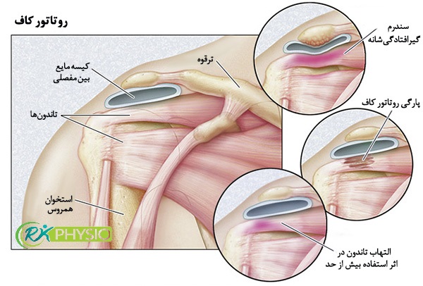 درمان پارگی شانه با فیزیوتراپی