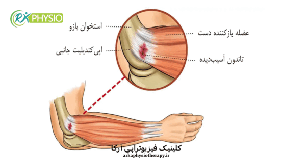 درمان تنیس البو با فیزیوتراپی