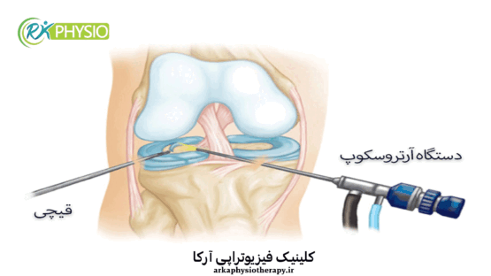 آرتروسکوپی چیست؟