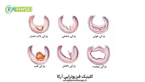 درمان مینیسک در سعادت آباد تهران