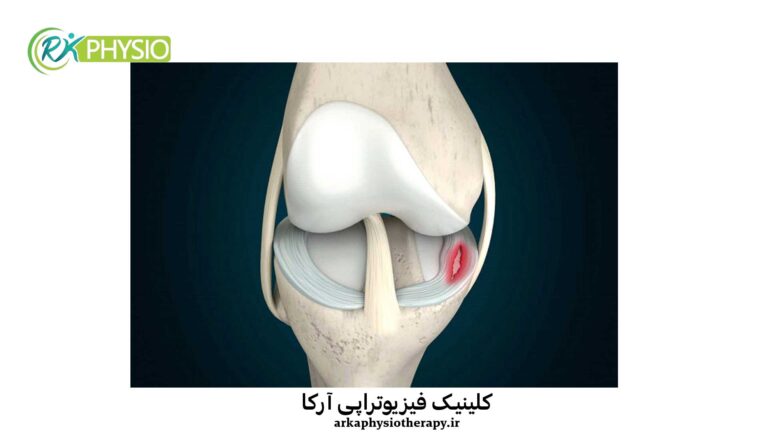 درمان مینیسک در سعادت آباد تهران