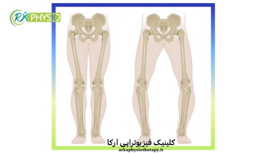 پای (زانو) پرانتزی چیست؟ از تشخیص تا درمان