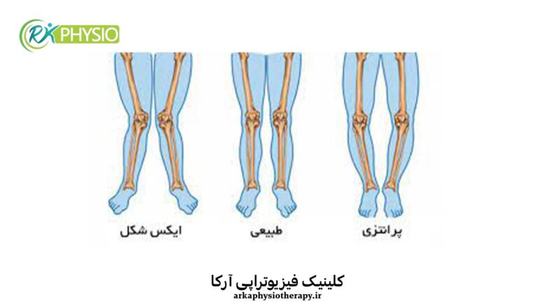 پای (زانو) پرانتزی چیست؟ از تشخیص تا درمان