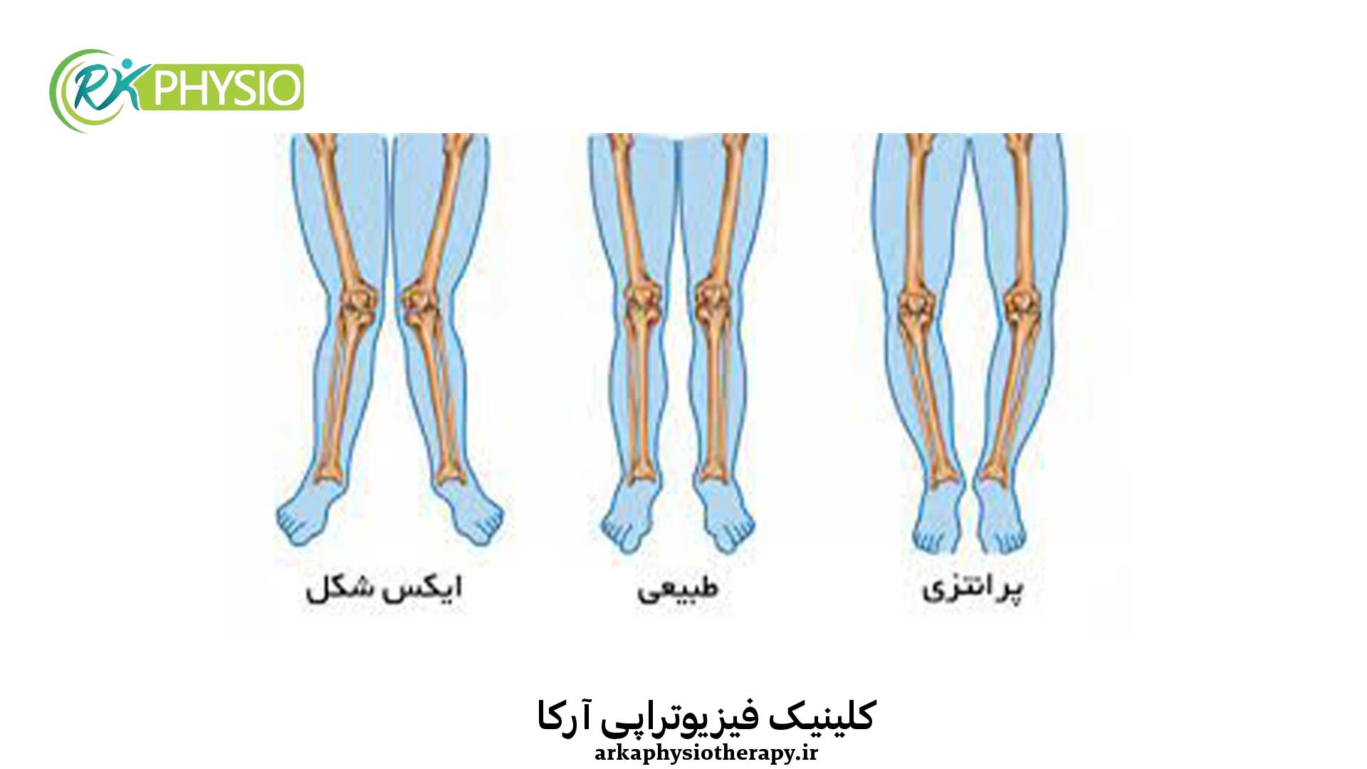 زانوی پرانتزی چیست؟ از تشخیص تا درمان