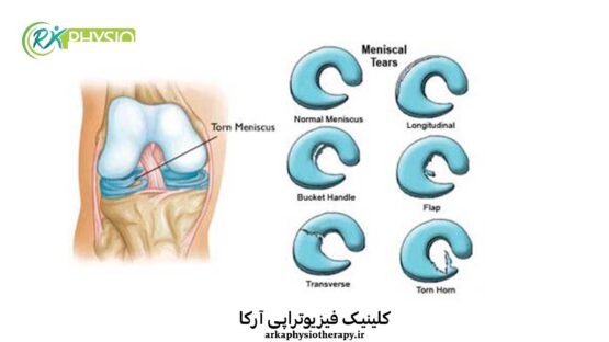  درمان پارگی مینیسک با فیزیوتراپی