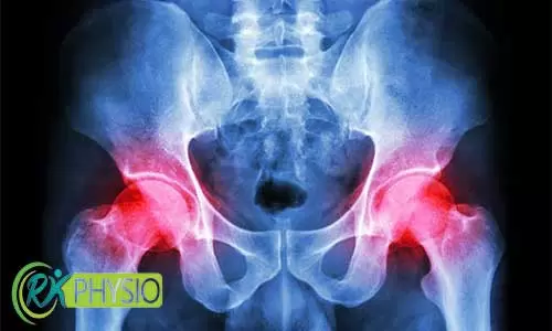 درمان سندروم گیرافتادگی مفصل ران با فیزیوتراپی