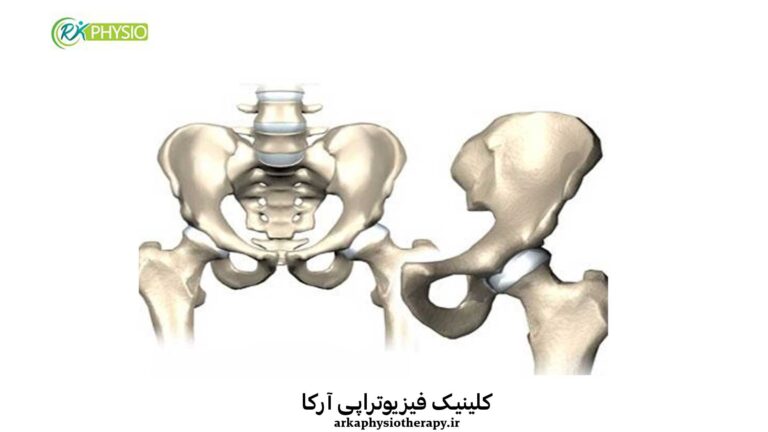 درمان آرتروز لگن با فیزیوتراپی