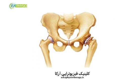 درمان آرتروز لگن با فیزیوتراپی