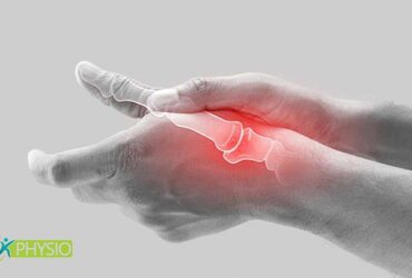 فیزیوتراپی سندروم دکورون