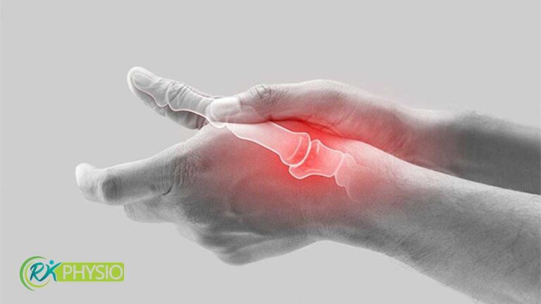 فیزیوتراپی سندروم دکورون