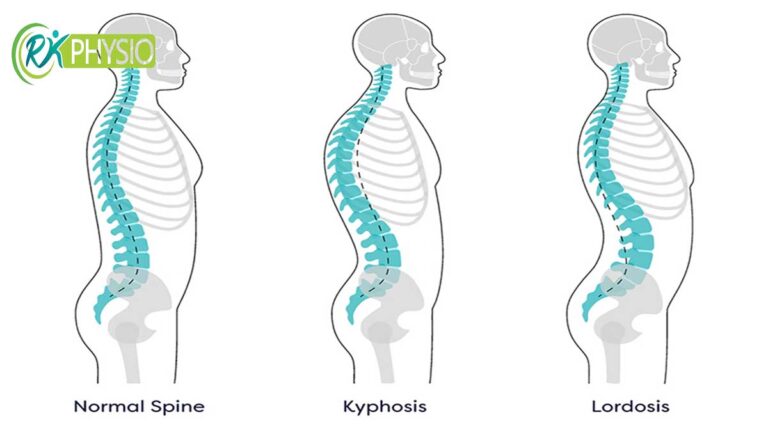 درمان قوز کمر (کیفوز یا گوژپشتی) در نوجوانان