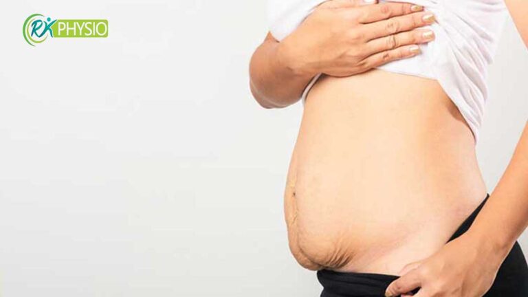 درمان دیاستاز شکمی با فیزیوتراپی