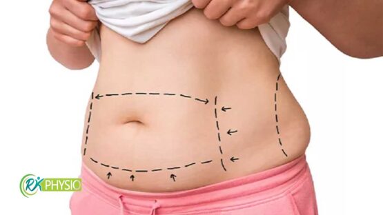 درمان دیاستاز شکمی با فیزیوتراپی