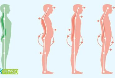 فیزیوتراپی پوسچر برای اصلاح فرم بدن