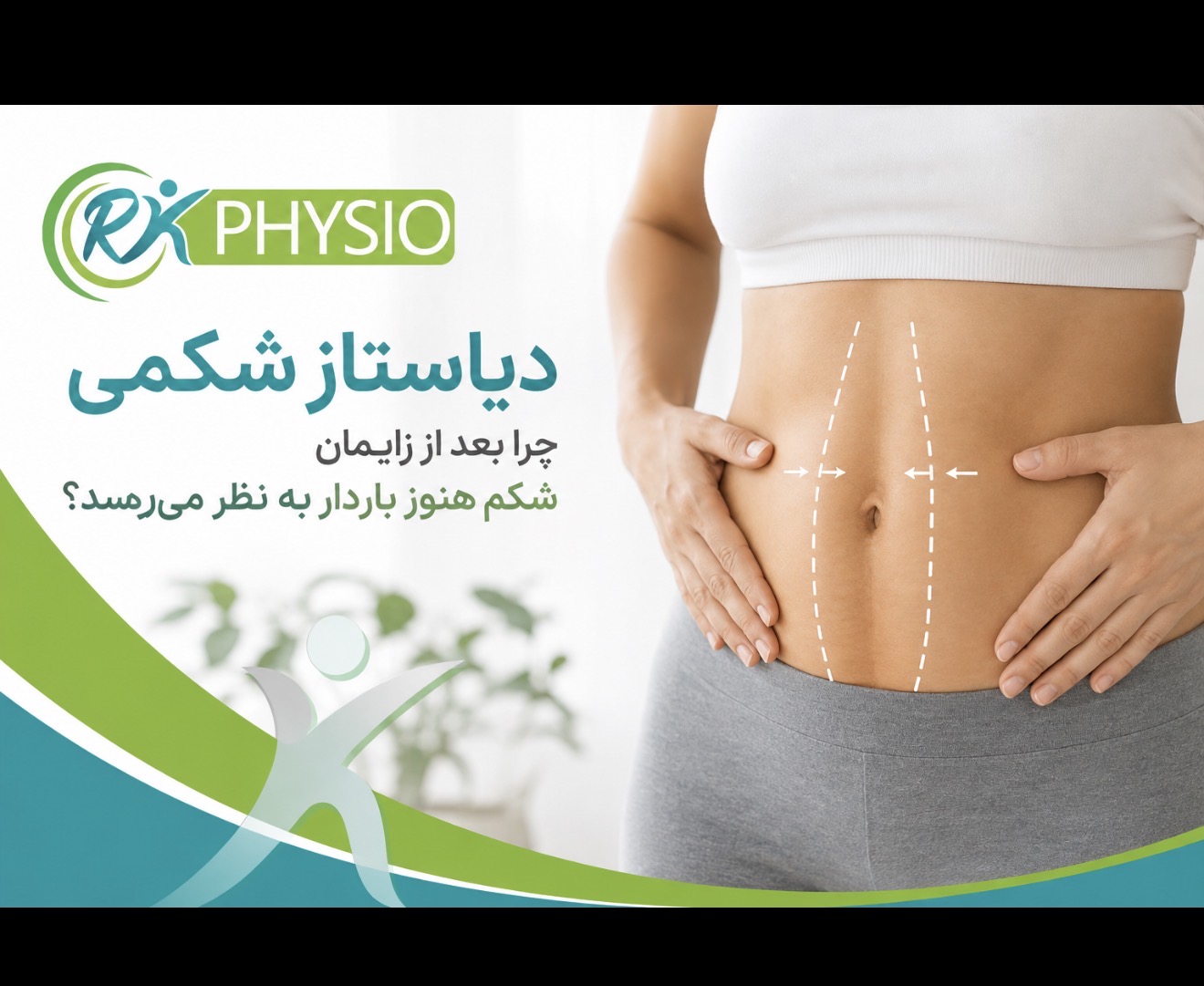 دیاستاز شکمی بعد از زایمان؛ چرا شکم هنوز باردار به نظر می‌رسد؟